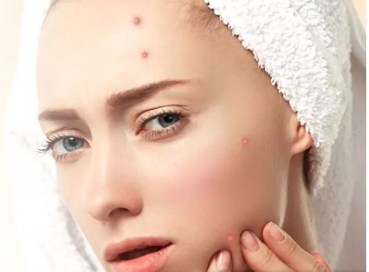 Acne Treatment in Delhi by aman - Ourboox.com