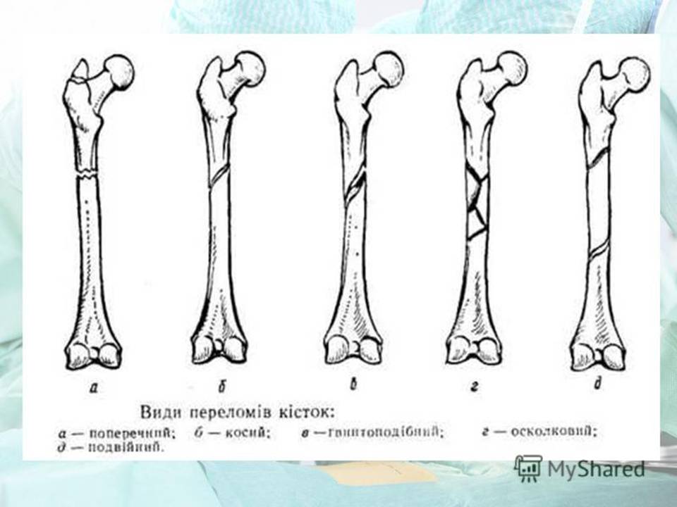 Перелом формы в рисунке