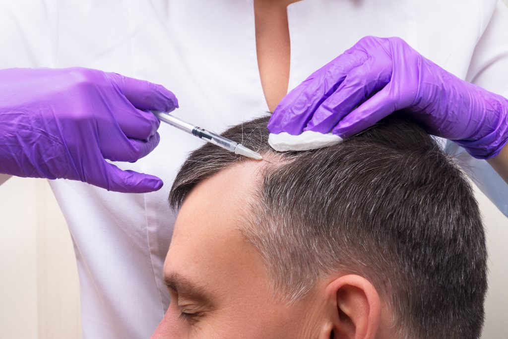 PRP For Hair Loss