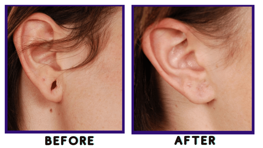 What are the reasons of earlobe stretching? How does it work? Ourboox