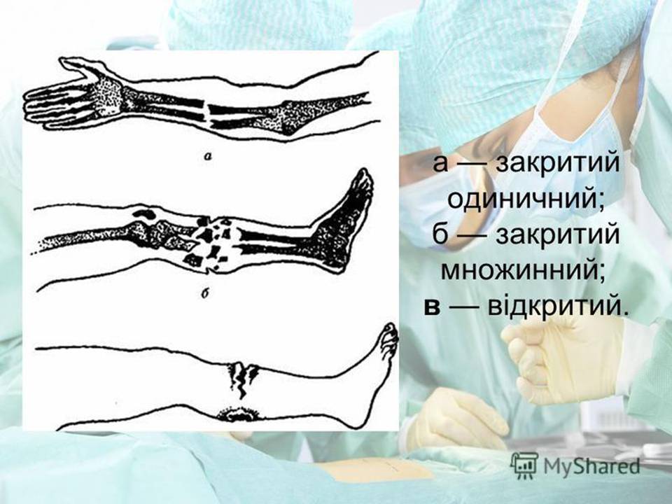 Перша допомога при переломах 8клас by Pidgorodetska Olena - Ourboox.com