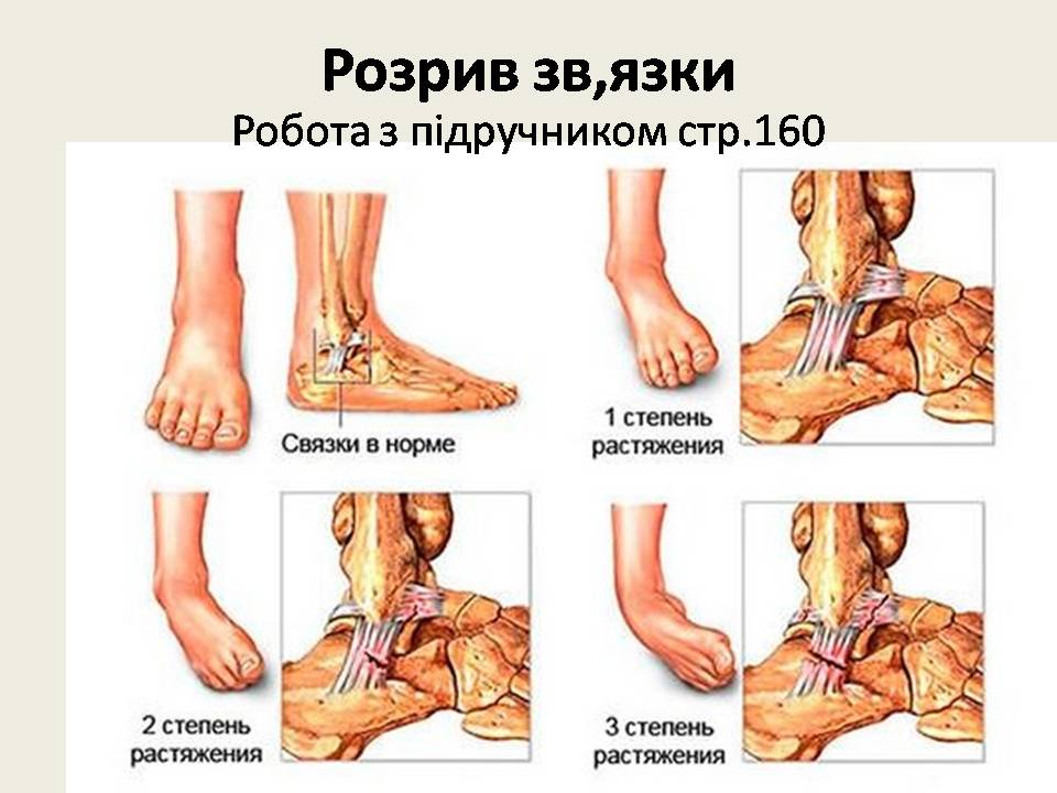 Перша допомога при переломах 8клас by Pidgorodetska Olena - Ourboox.com