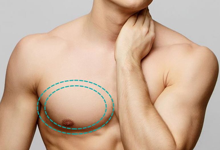 gynecomastia surgery